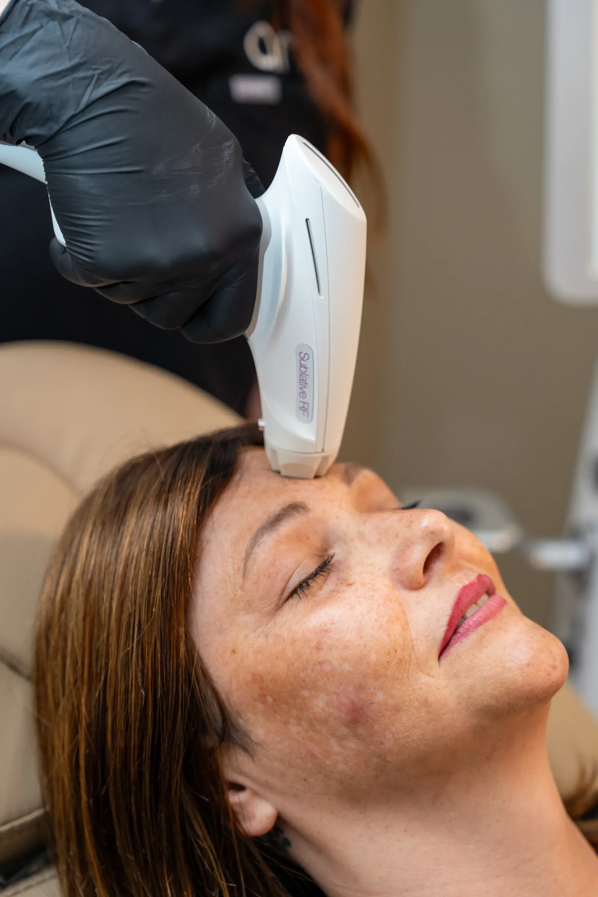 Candela Matrix sublative handpiece treatment ANU Elizabethtown Kentucky