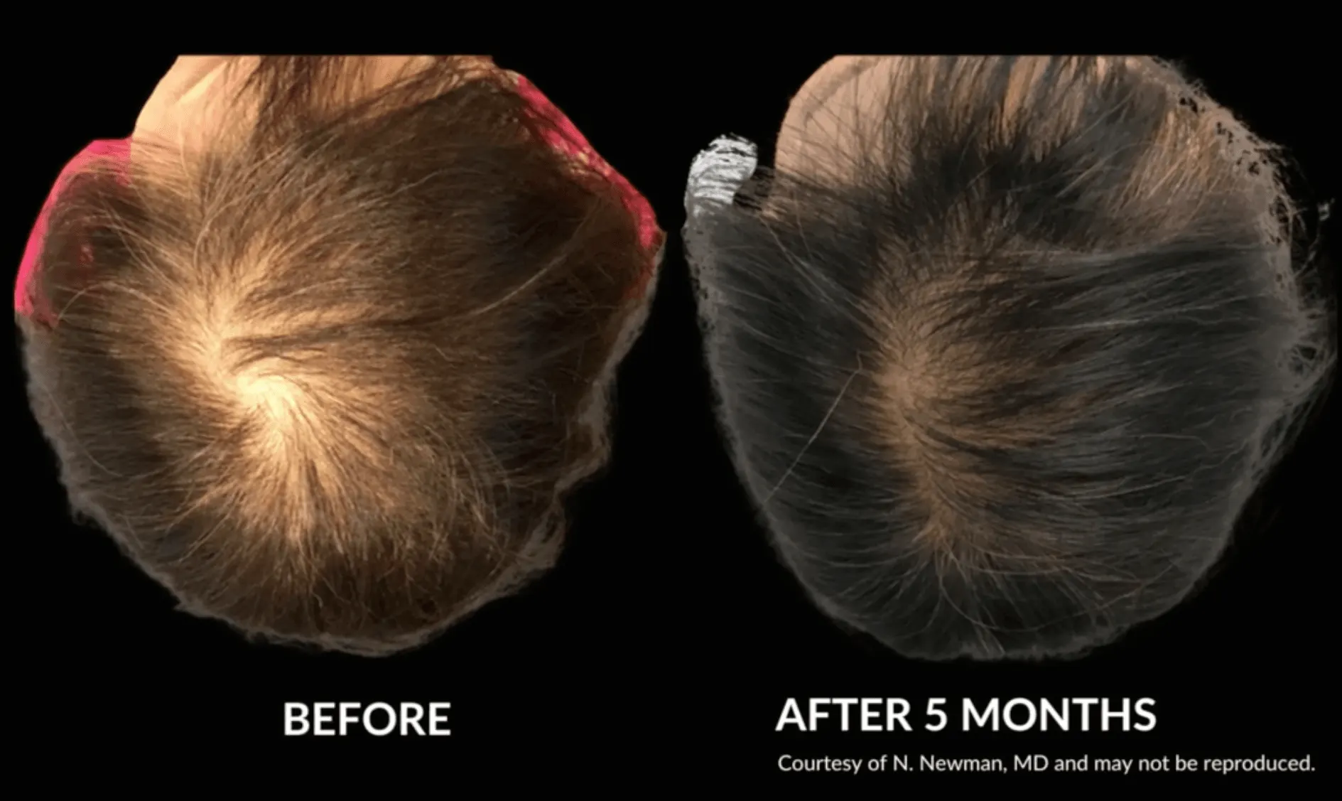 hair restoration with DE|RIVE before and after