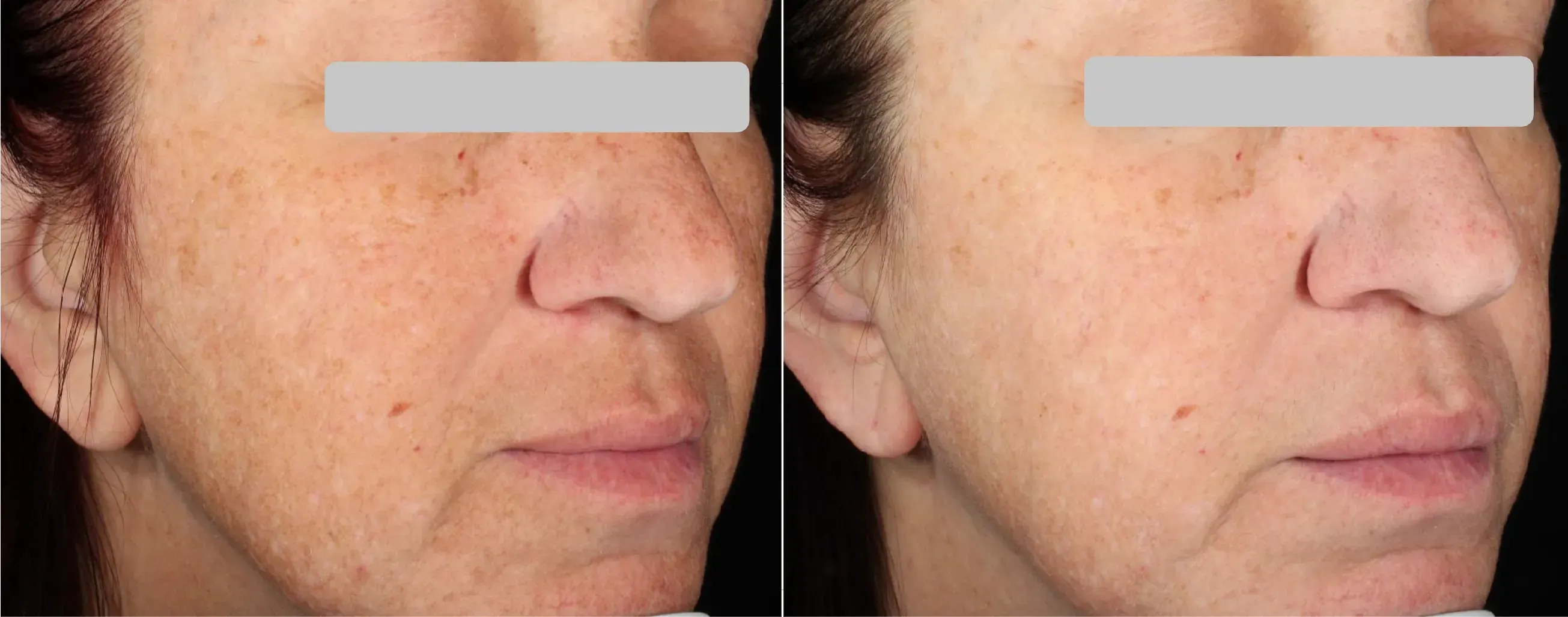 Matrix effect on the face
