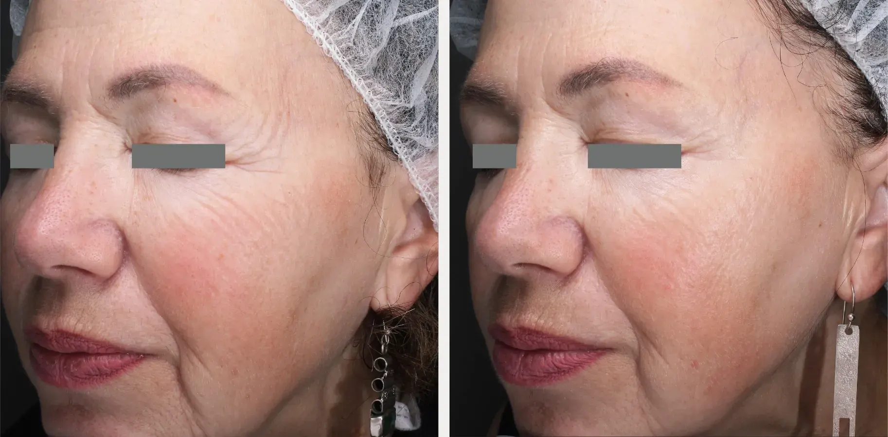 Matrix effect for crow’s feet