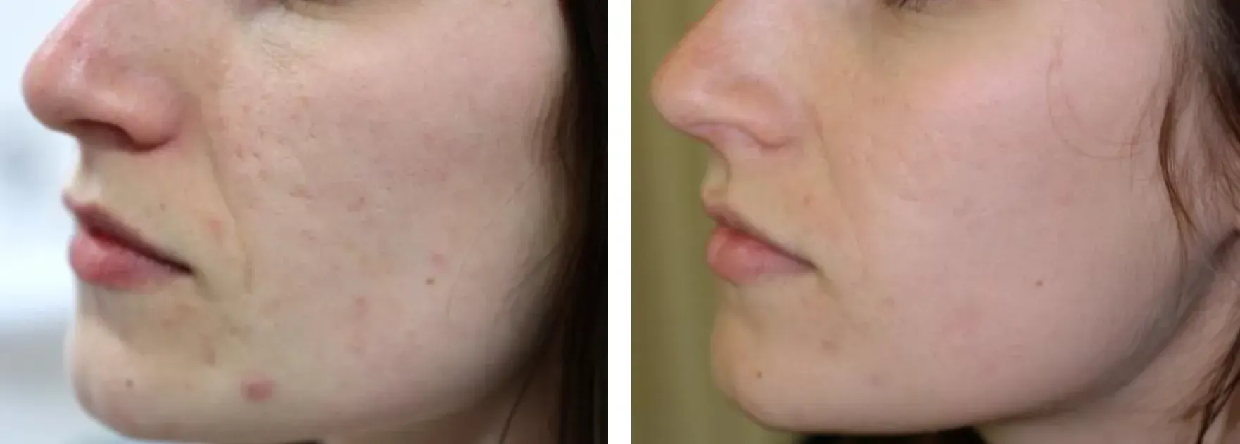 Sublative effect on cheeks