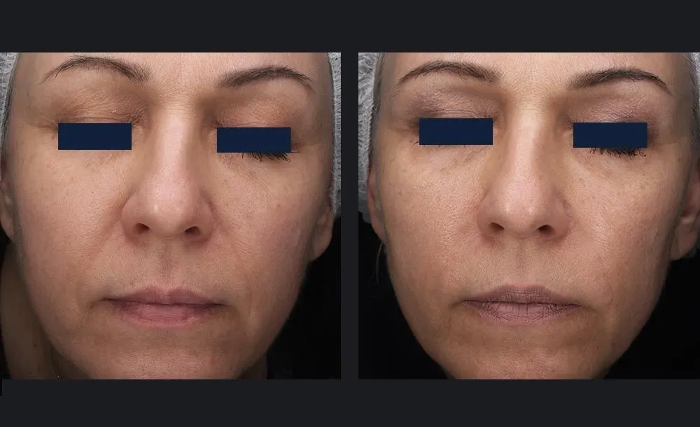 Sublative RF with Candela Matrix - Before and After