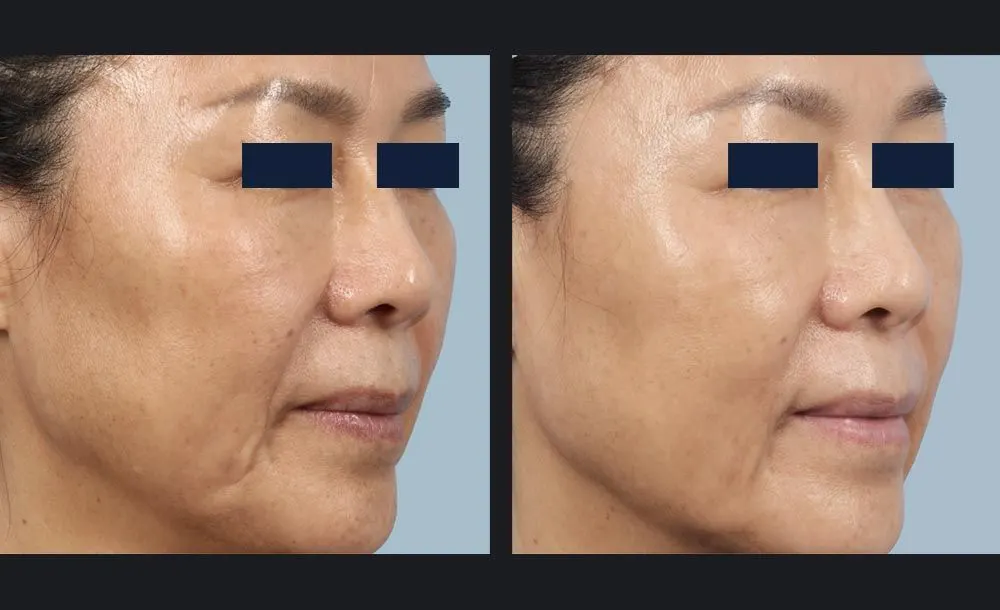 Sublative RF with Candela Matrix - Before and After