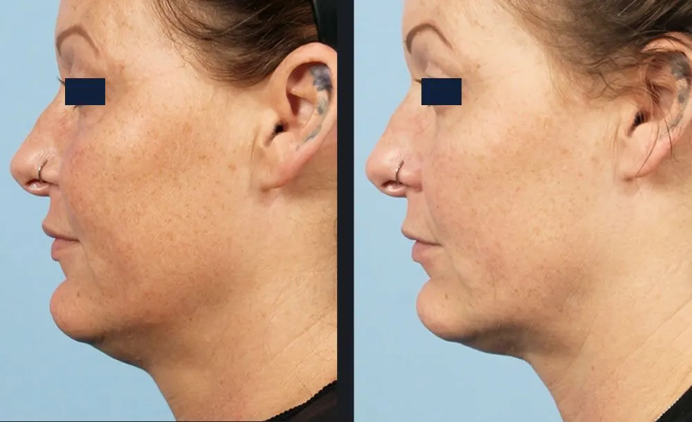 Sublative RF with Candela Matrix - Before and After