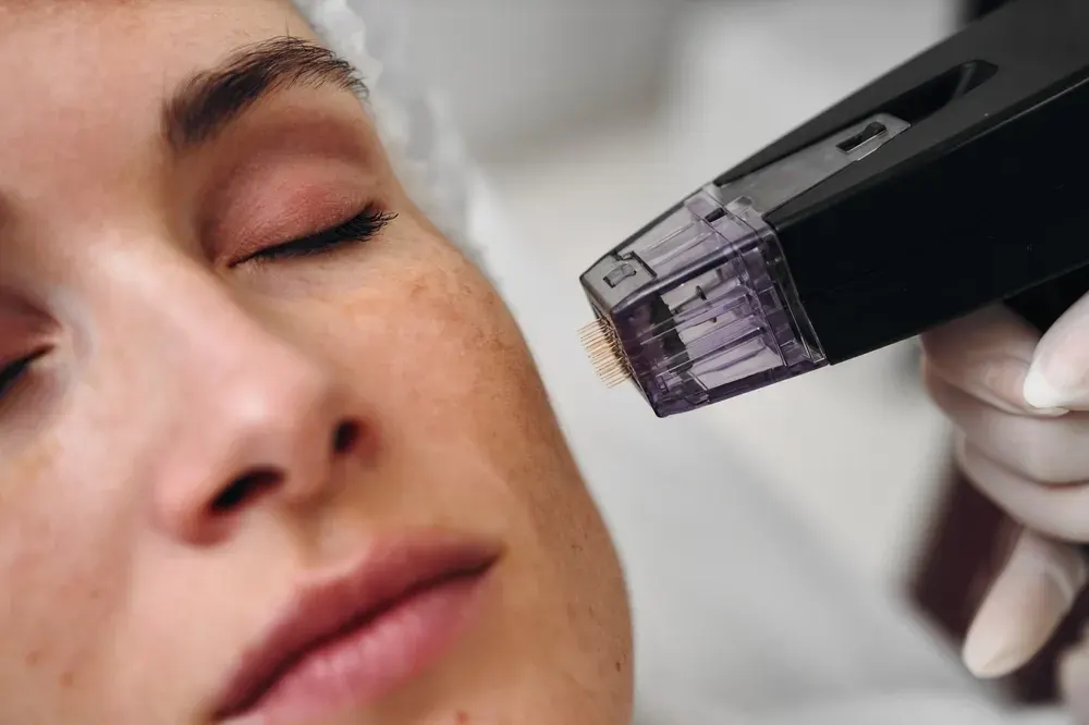Confident patient considering RF Microneedling