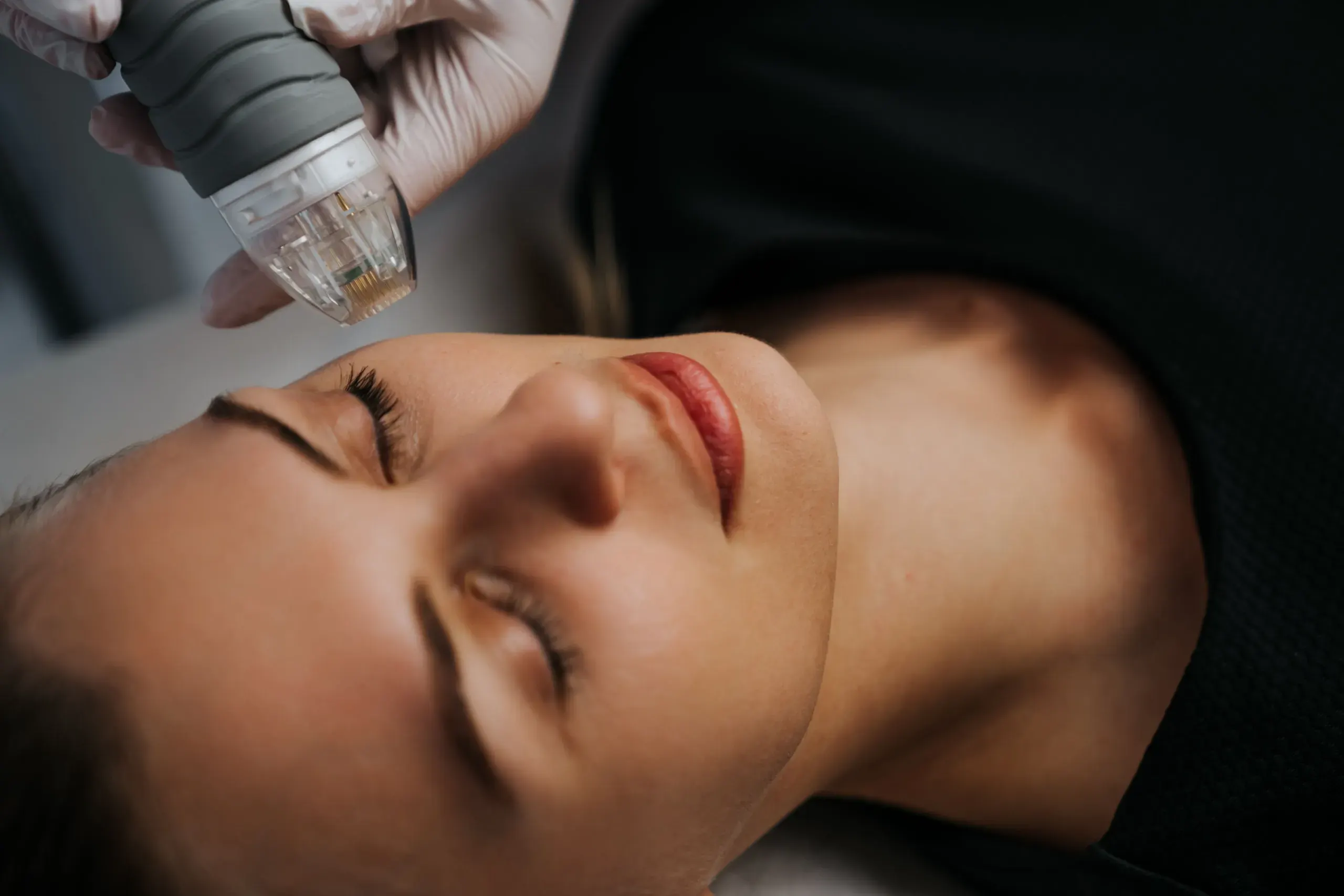 RF Microneedling